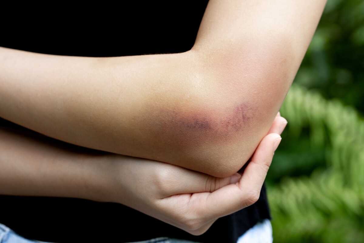 hematoma-feed-1
